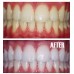 Pola Day 6% Teeth Whitening Bleaching Gel 3g Syringe 