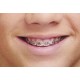 Braces/Orthodontics